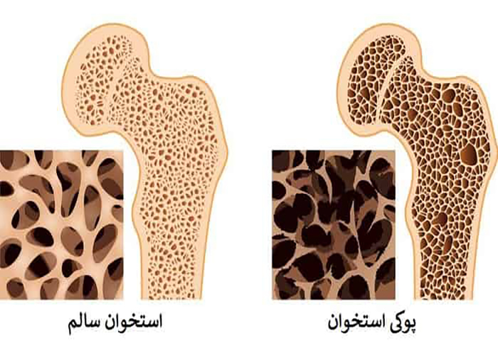 پوکی استخوان (Osteoporosis) 