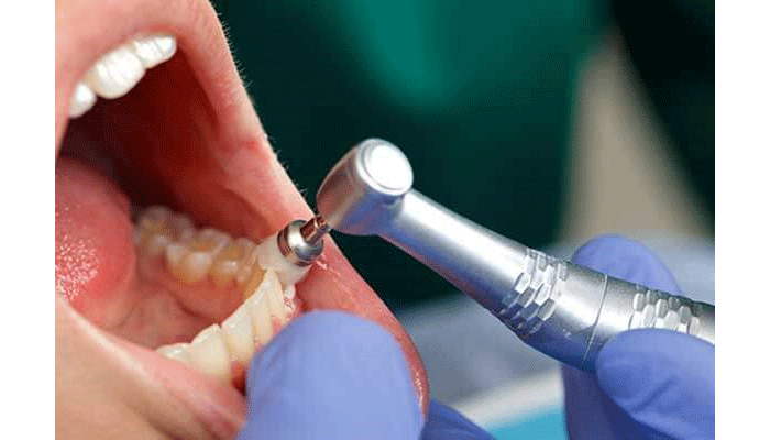 فواید و اهمیت جرمگیری دندان