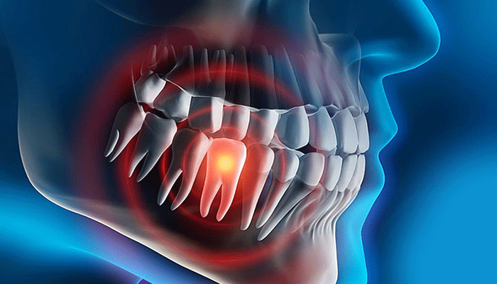 عفونت دندان