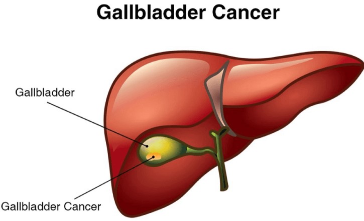 سرطان کیسه صفرا