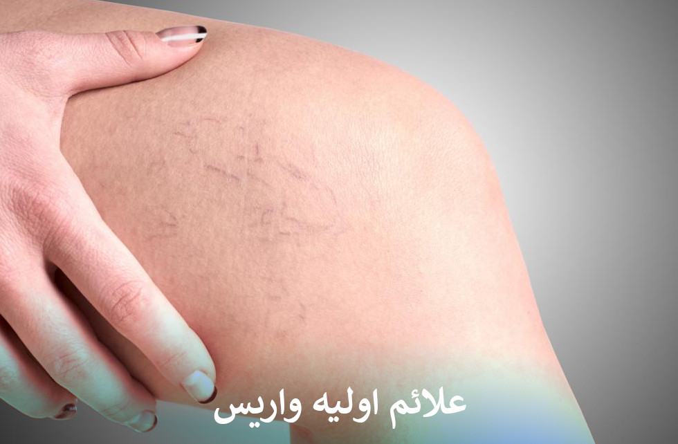 علائم اولیه واریس