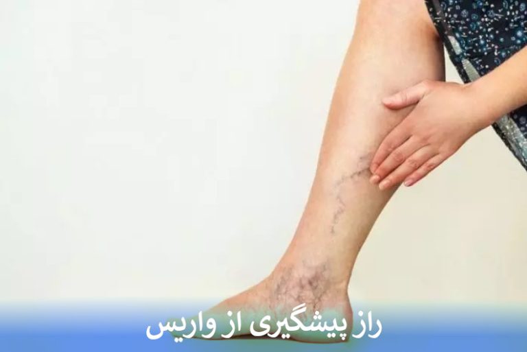 راز پیشگیری از واریس